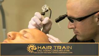 Scalp Micropigmentation by Hair Train