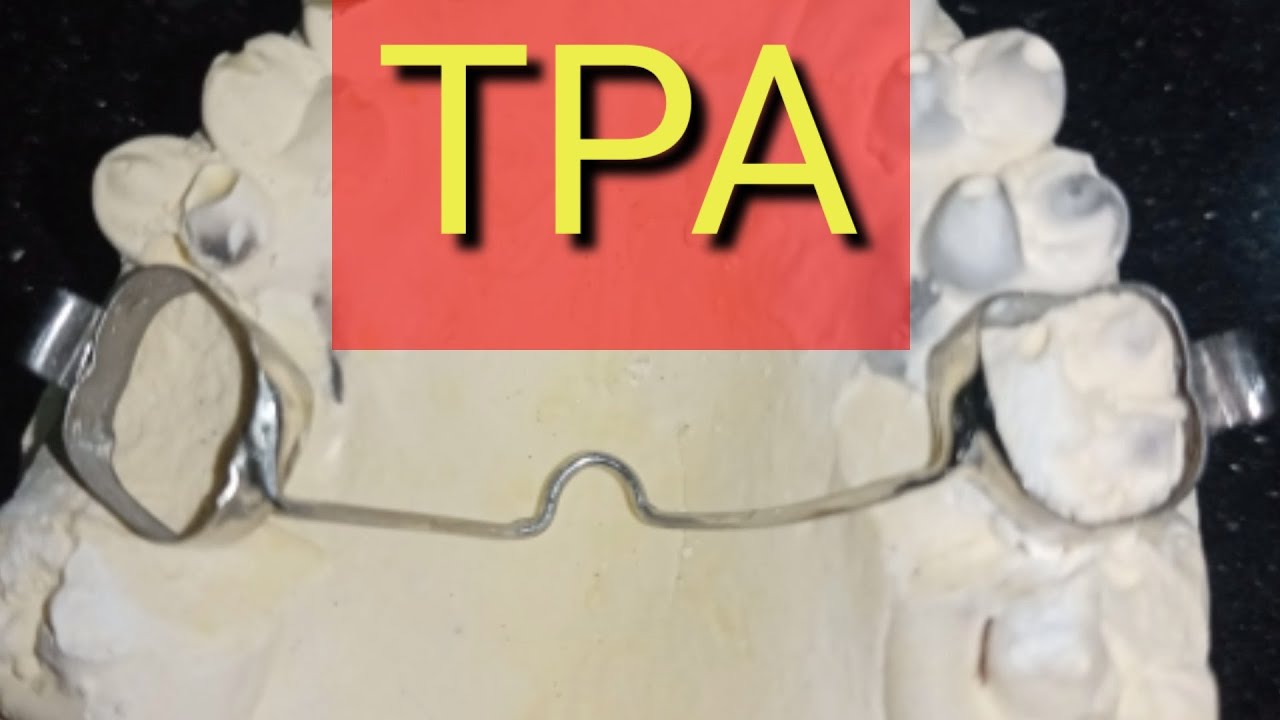 How to make a TransPalatal Arch TPA Orthodontic Appliance by Haider