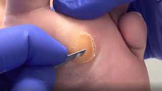 BIGGEST CALLUS EVER - Removing Hard Foot Callus #11 - Foot Care Podiatry