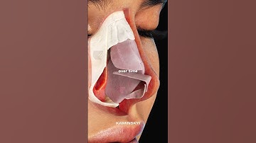 The reason for the drooping of the nasal tip after rhinoplasty ⭕️ #kaminskyi