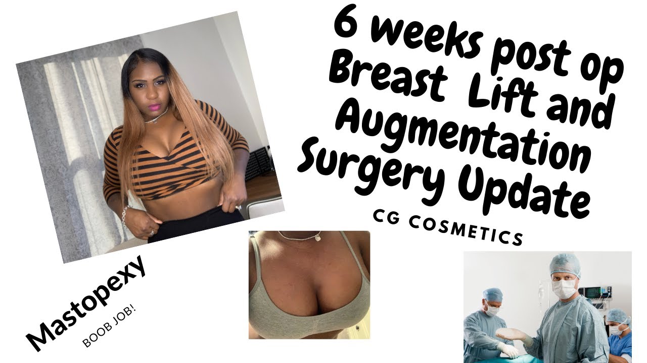 Before and after breast augmentation, 6 weeks post op : r/PlasticSurgery