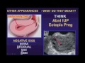 Ultrasound Evaluation of Ectopic Pregnancy