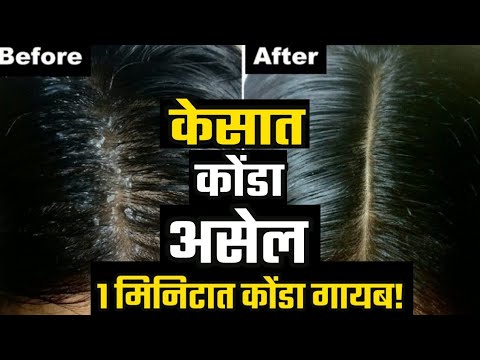 केसातील कोंडा व कोंडा मिटवा!करा हा घरघुती उपाय