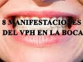 8 manifestaciones de VPH en la boca