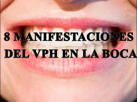 8 manifestaciones de VPH en la boca