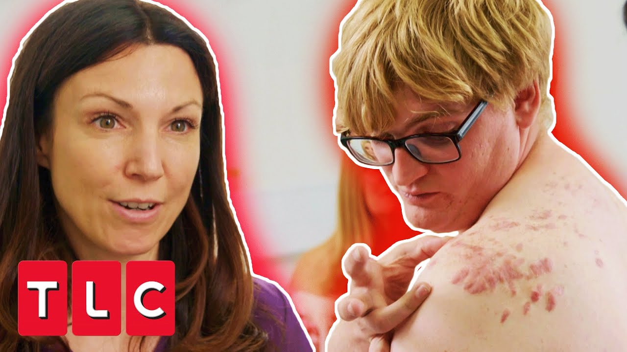 Dr. Emma Removes Autistic Man’s Acne Scars | The Bad Skin Clinic