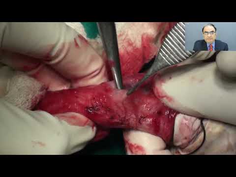 Penectomy for Carcinoma Penis - step by step - Prof. Chintamani