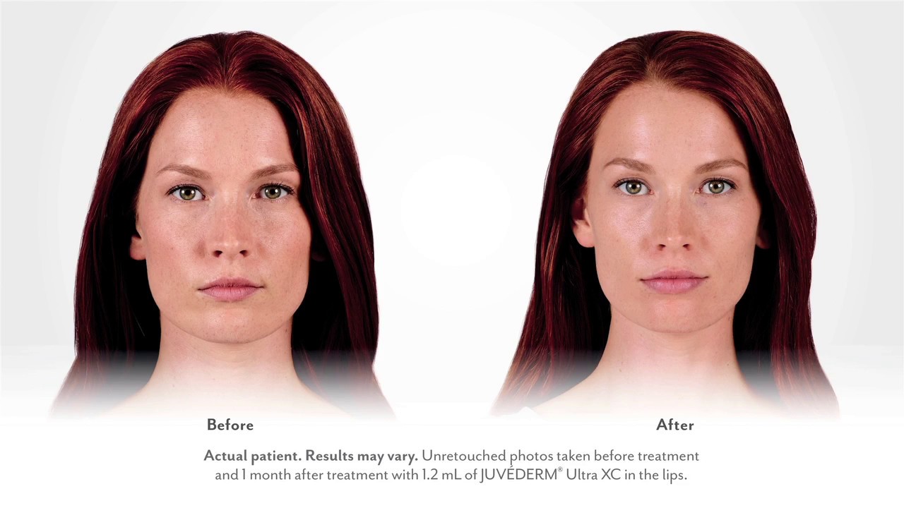 Juvederm: Meet Clancy