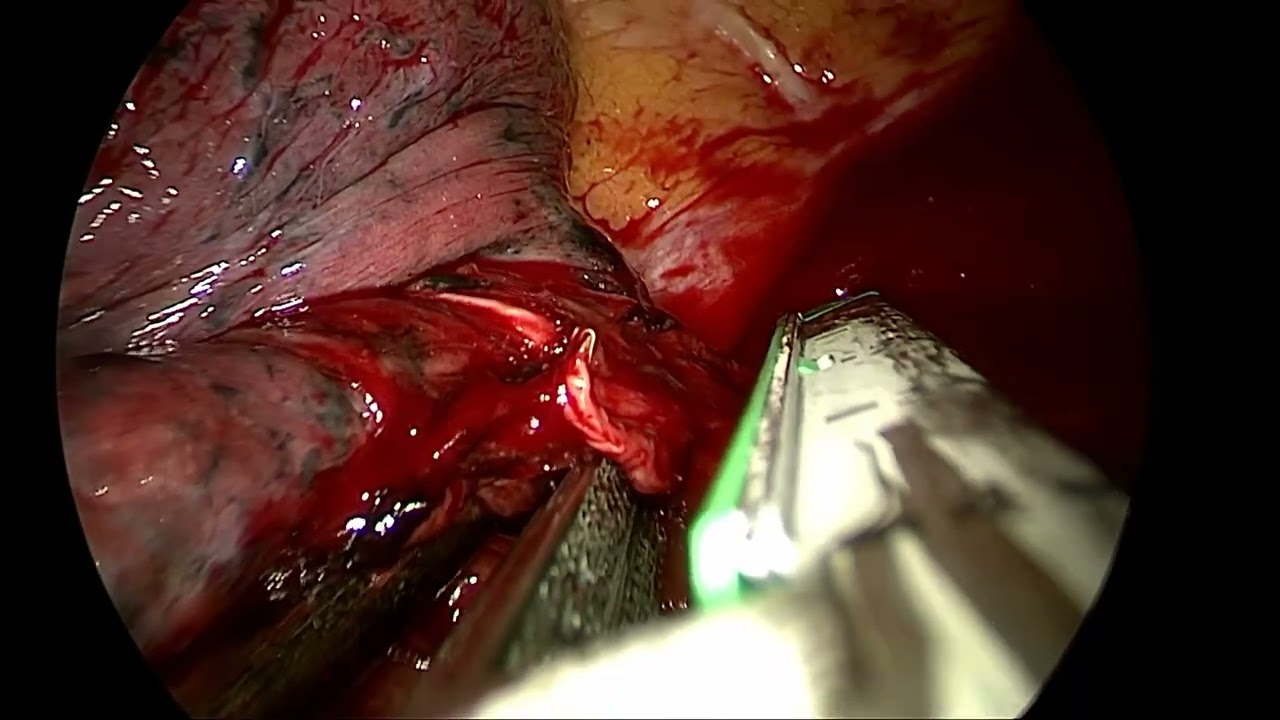 Uniportal VATS right bilobectomy and bleeding control