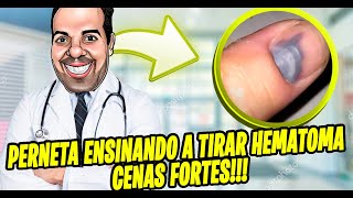 Coágulo de no caseiros sangue para polegar remédios