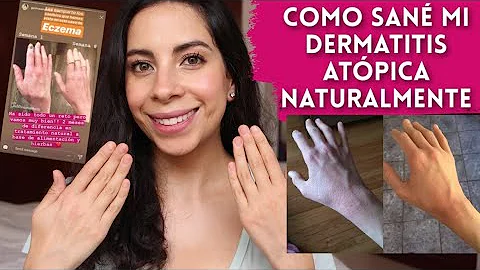 ¿Es buena la vaselina para el eczema?