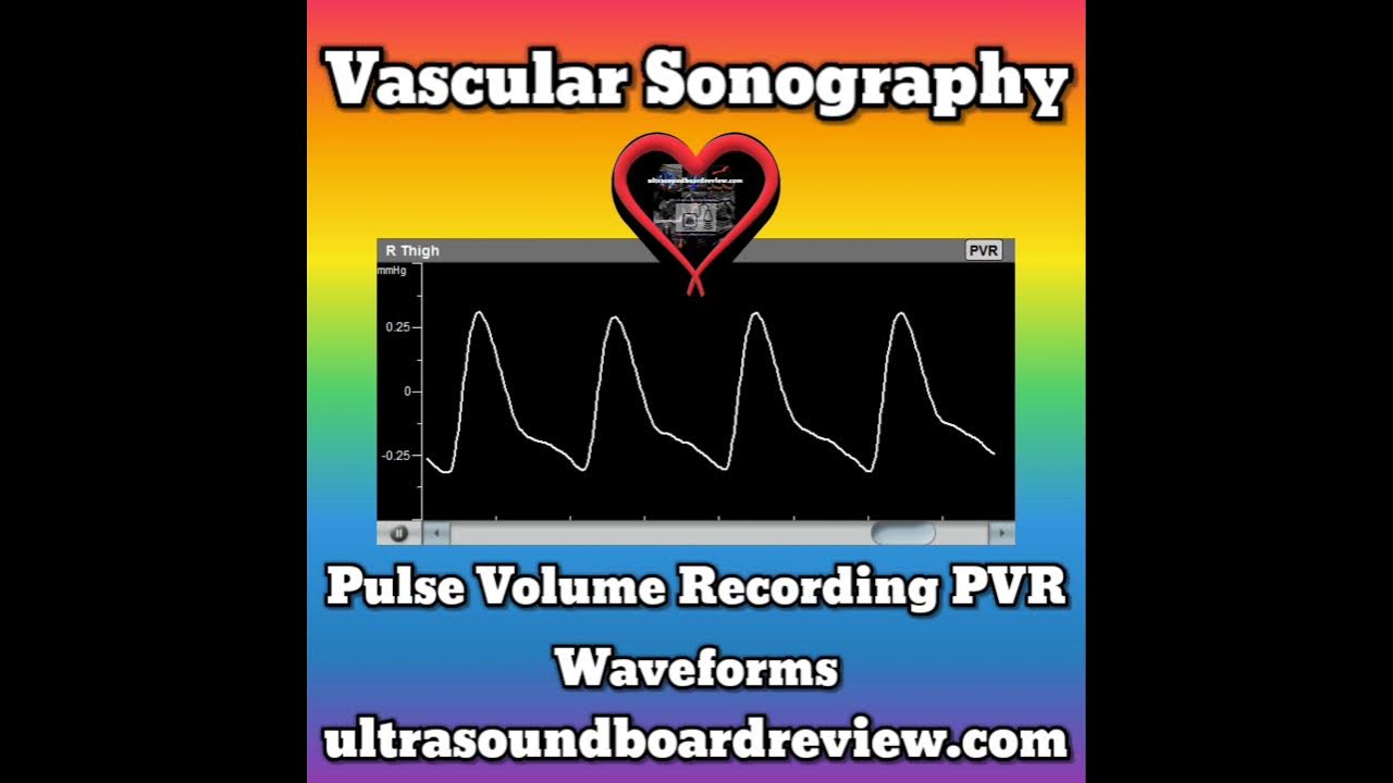 Pulse Volume Recording Waveforms YouTube