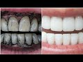 Teeth whitening at home in ONLY 2 Minutes |  طريقة تبييض الأسنان الصفراء في دقيقة ! لن تصدق النتيجة