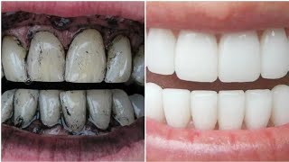 Teeth whitening at home in ONLY 2 Minutes |  طريقة تبييض الأسنان الصفراء في دقيقة ! لن تصدق النتيجة