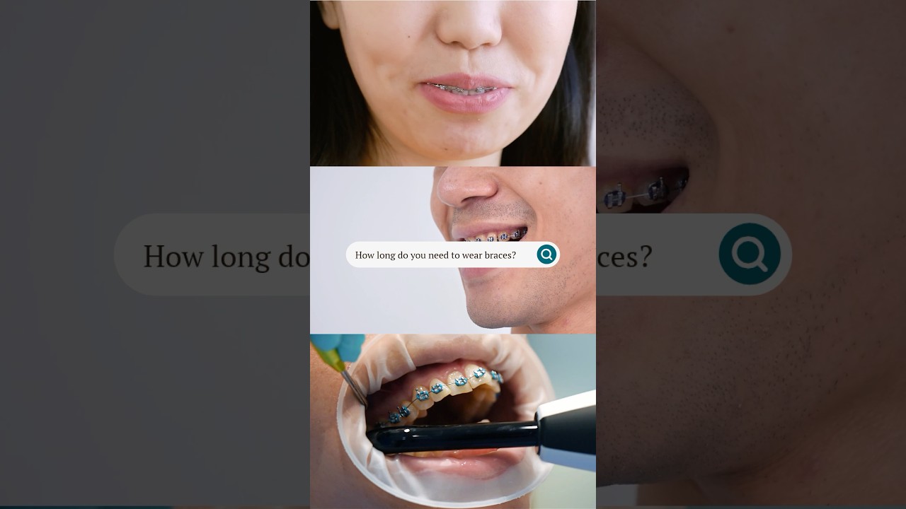 How Long Do Braces Take? What to Expect