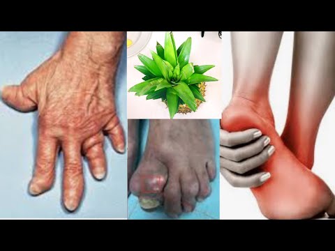 YOUN NAN FASON OUKA TRETE MALADI NAN ZO, KÒ ANFLE (ARTHRITIS)