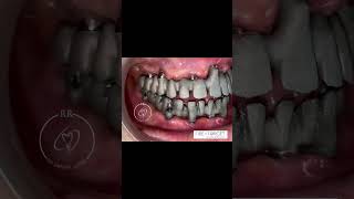 Dental implant prosthesis done in rr dental lab screenshot 5