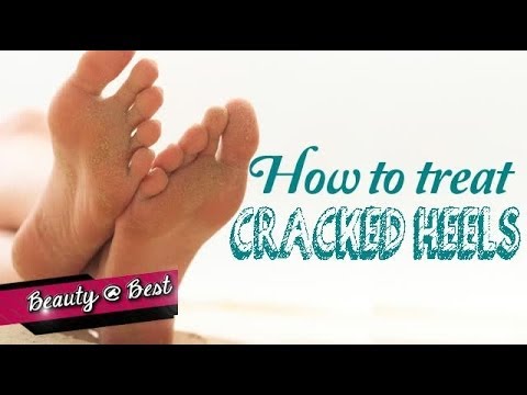 How to treat cracked heels