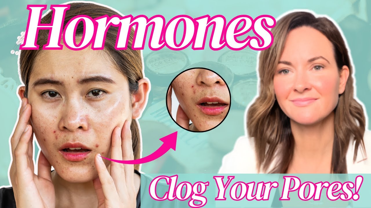 Hormonal Acne in Pregnancy | Safe Treatments for You and Your Baby