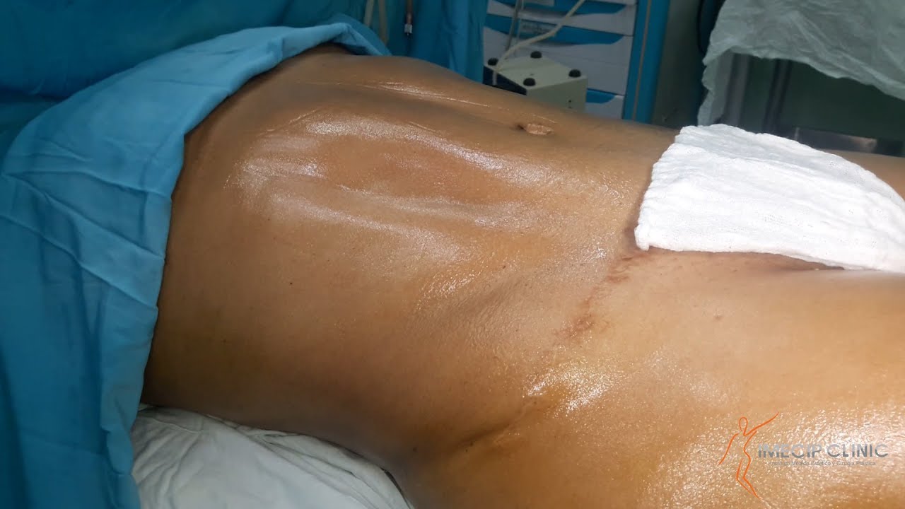 HIDROLIPO 26 lipoma 意味