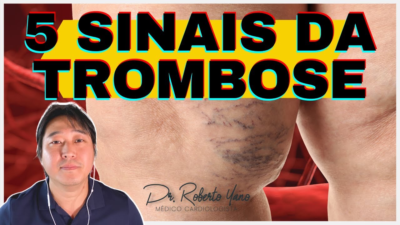 5 sinais da trombose!