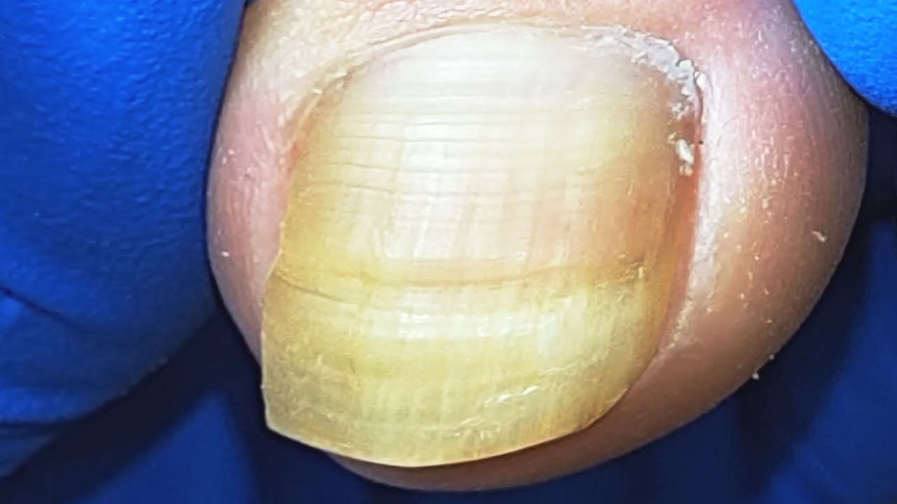 Thick and long nails bother patients YouTube