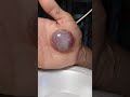 Popping blister part 1