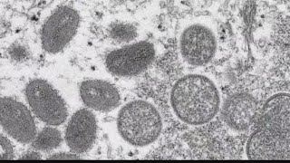 Biden administration to name Monkeypox coordinator