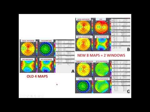 Vídeo: Regularización Corneal Central (RCC): Un Enfoque Alternativo En El Tratamiento Del Queratocono