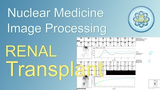 Renal Transplant image Processing, in nuclear medicine
