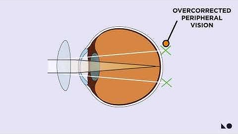How Ortho-K Works & How It Slows Myopia
