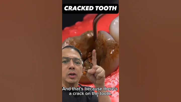 How to EASILY Extract a Cracked Tooth (First Molar) | In Office to Hands On Dental Training #shorts