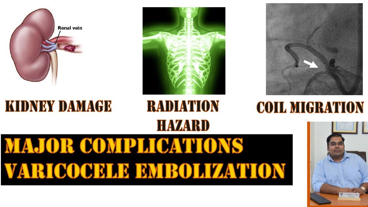 Complications of Varicocele Embolization  Microsurgery vs Embolization for  Varicocele 