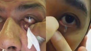 Eye Cyst (PART 1)