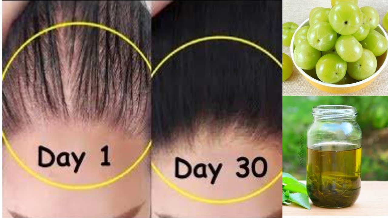 ತೆಳ್ಳಗಿರುವ ಕೂದಲು ದಟ್ಟವಾಗಿ ಮತ್ತೆ ಬೆಳೆಯಲು ನೆಲ್ಲಿಕಾಯಿ ಎಣ್ಣೆ ಹಚ್ಚಿ | Thin Hair to Thick Hair in 30 Days