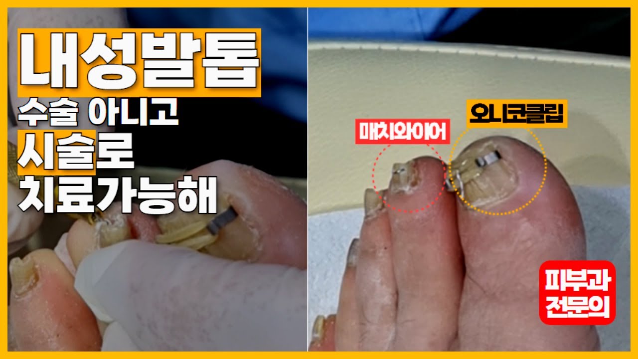 내성발톱 꼭 수술하지 않아도 됨 #내성발톱염증 #내성발톱치료 #피부과전문의