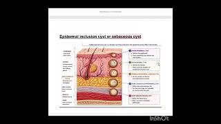 (ENGLISH VERSION)Learn CPT and ICD of MASS (SKIN VS LIPOMA)#codingtips#EPIDERMOIDCYST #SEBACEOUSCYST