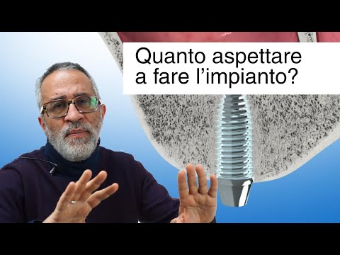 Impianto dentale: quanto aspettare dopo l&rsquo;estrazione?