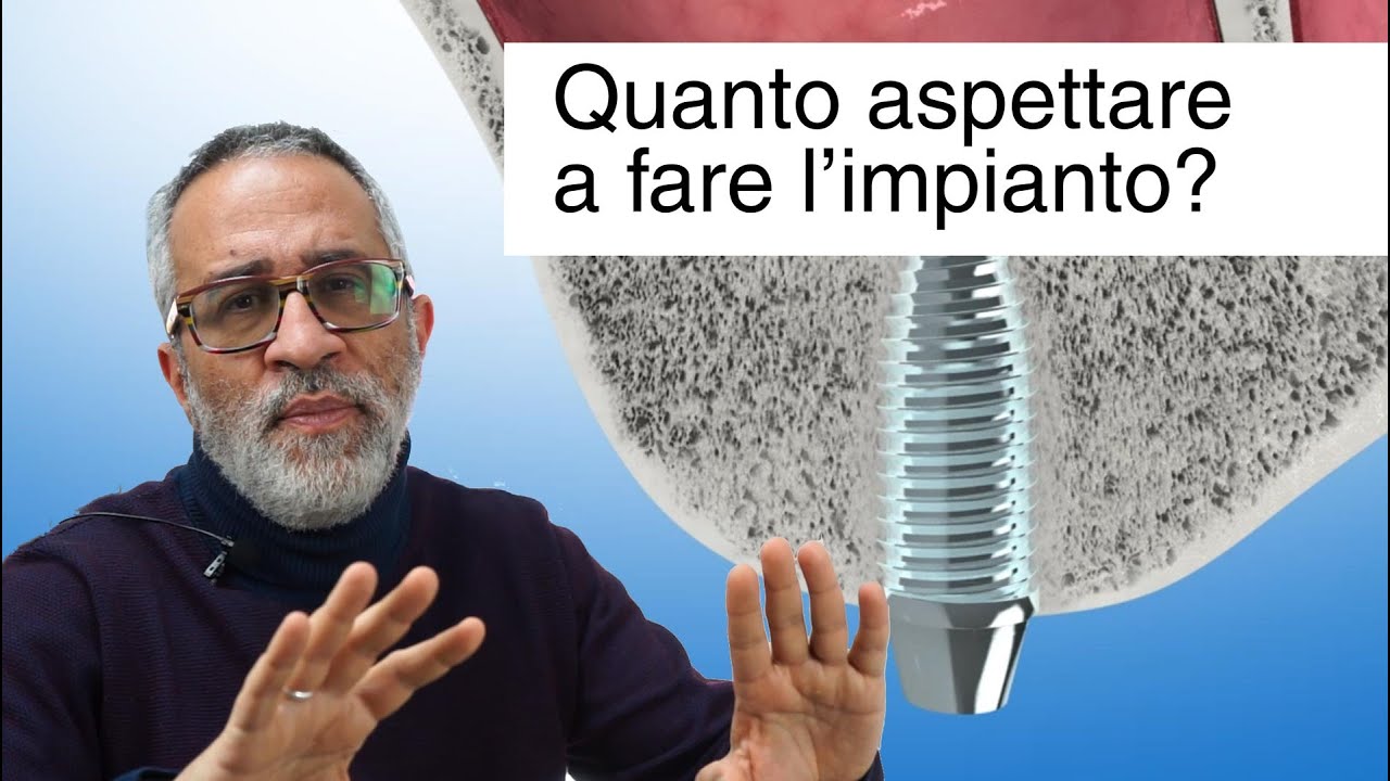 Impianto dentale: quanto aspettare dopo l'estrazione?
