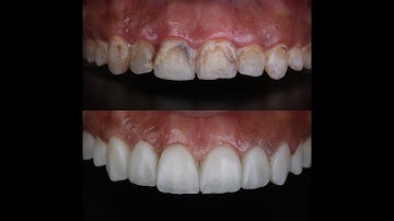Hollywood smile in only single visit using composite veneers with whiteology approach