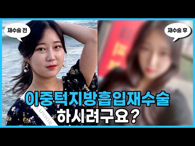 이중턱 지방제거를 했는데 효과가 없어서 재수술을 생각한다구요? l 압구정성형외과