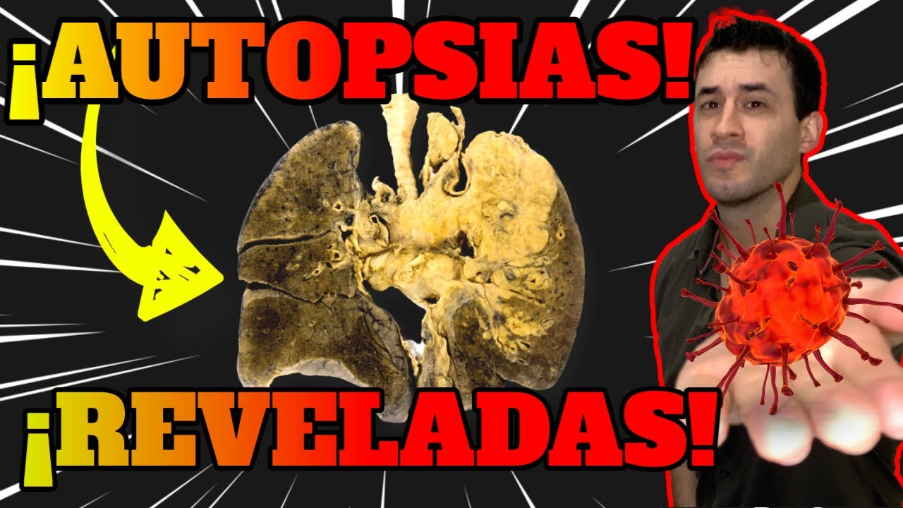 COVID 19|M�S de 40 AUTOPSIAS REVELADAS | AN�LISIS POST MORTEM de CAUSAS DE MUERTE