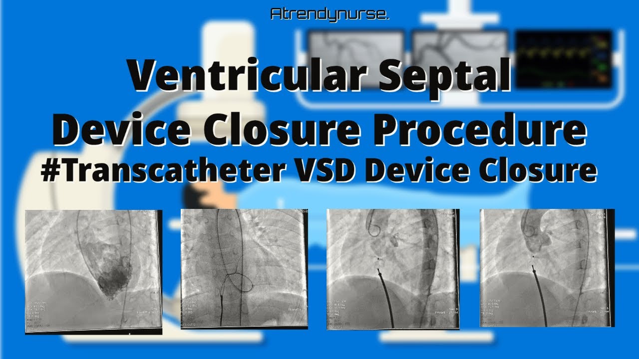 Device Closure Procedure, ASD, VSD, PDA