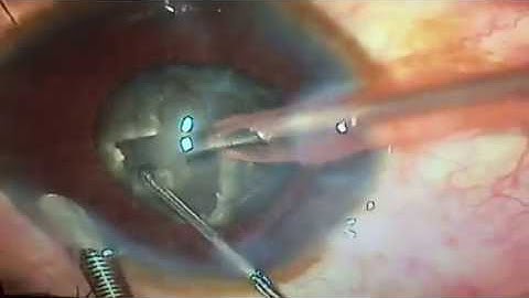 Divide and conquer in very hard cataract