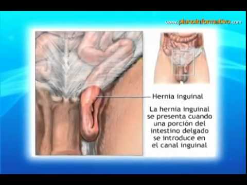 Bulto abdomen derecho y perdida de peso