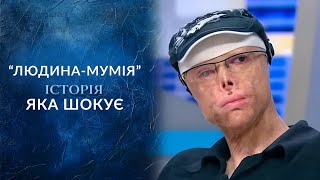 Болезнь сделала из меня мумию (полный выпуск) | Говорить Україна