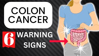 6 Warning Signs of COLON CANCER You Should NEVER Ignore