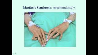 Marfan's Syndrome - CRASH! Medical Review Series