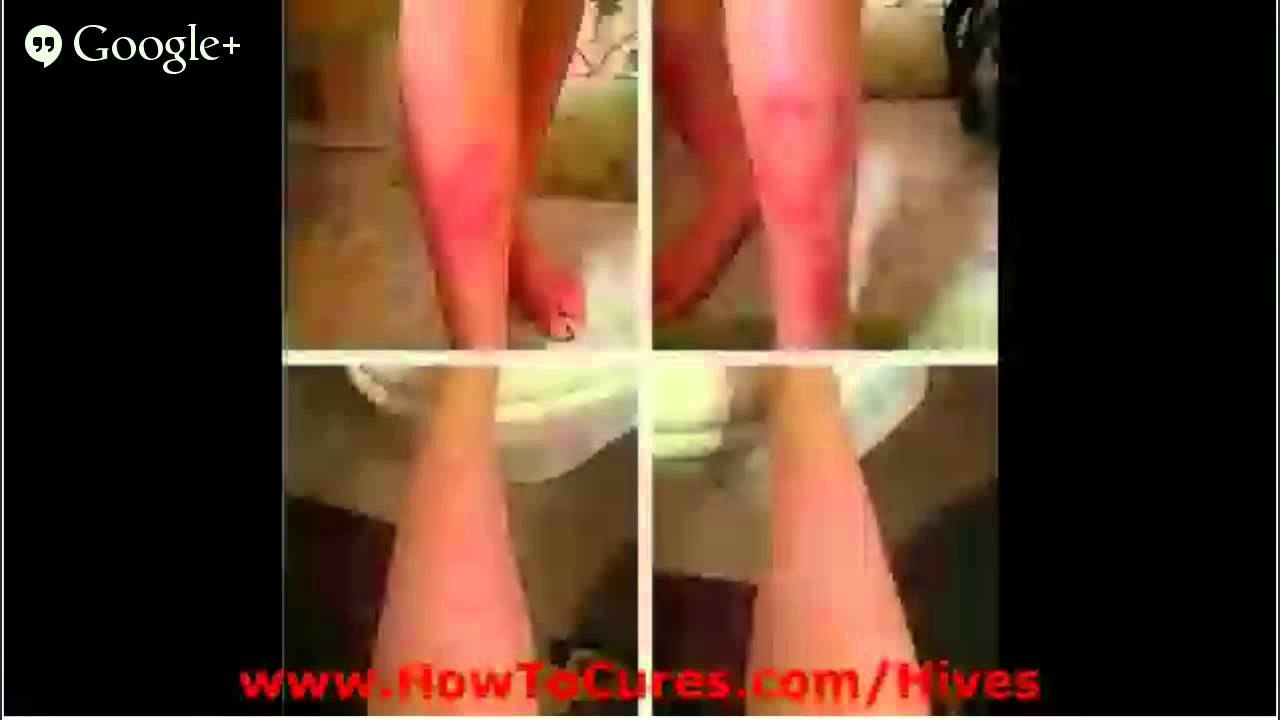 How To Get Rid Of Hives - Cures For Soothing Solar Urticaria - How To Get Rid Of Hives - YouTube