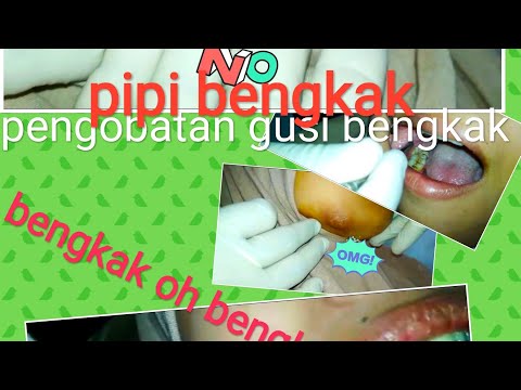 Video: Pembengkakan Gigi Kebijaksanaan